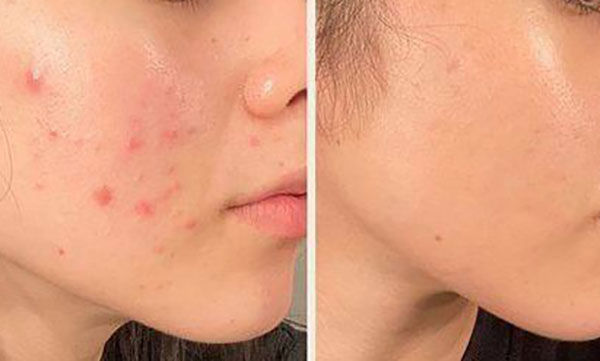 درمان جوش صورت با لیزر 3